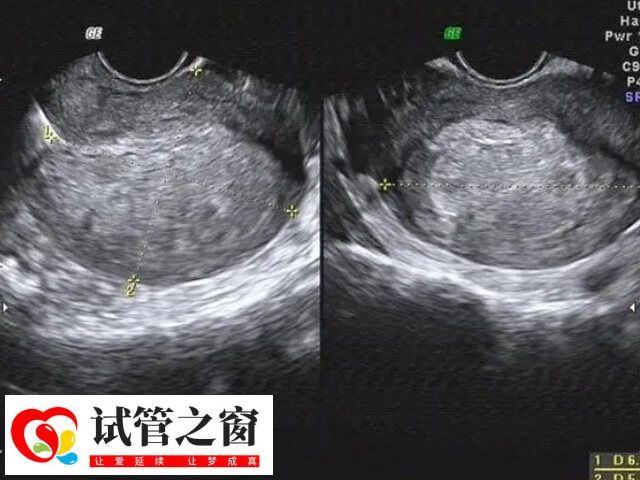 输卵管积水产生的胚胎毒性作用