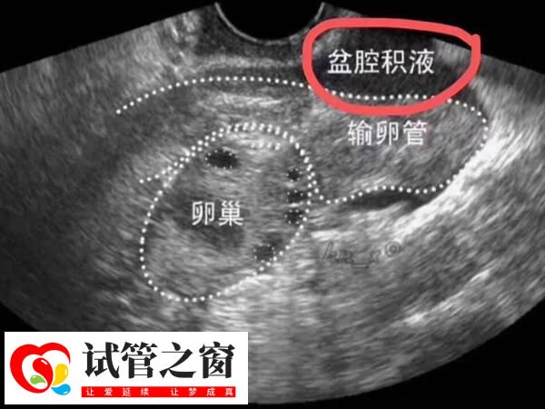 输卵管积液中存在细菌和病毒等病原体