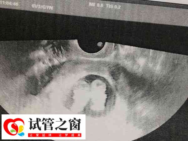肺结核可能影响胚胎移植