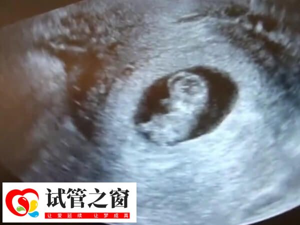 试管一超主要是看孕囊着床位置