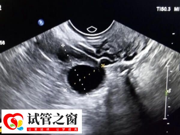 促排卵期间将持续进行卵泡监测