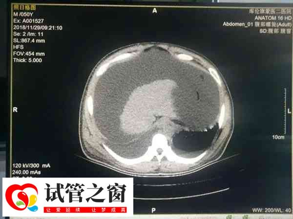 试管婴儿是一种体外受精技术