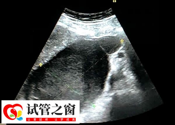 试管婴儿移植后可能会感到腹部疼痛和不适