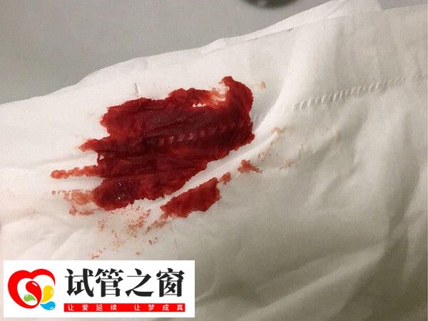 做试管受孕失败后会有出血的情况