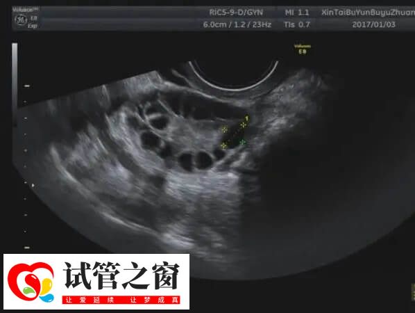 多囊卵巢为临床常见的不孕症