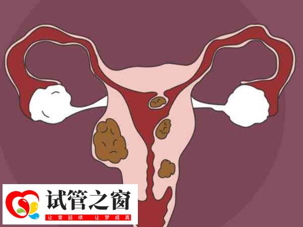 子宫肌瘤在促排期间注意密切监测