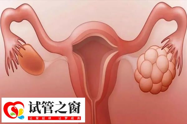 缺乏运动是多囊反复原因之一