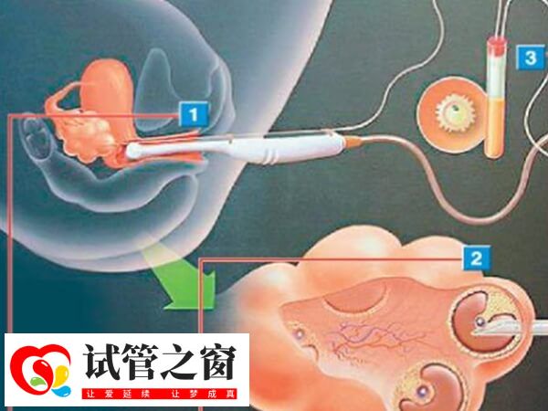 双腔取卵和单腔取卵各有特点