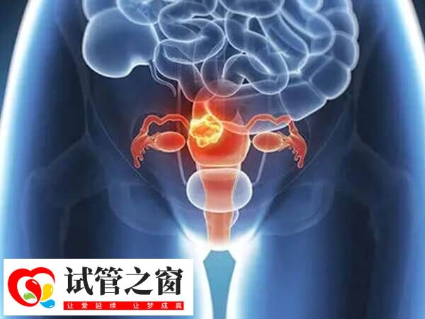 不当使用贺美奇会导致卵巢过度刺激