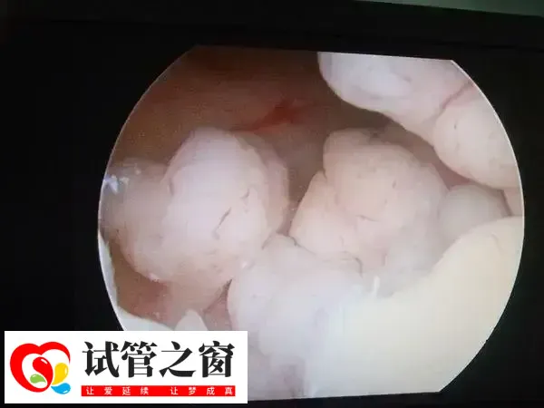 宫腔镜在临床上已经被广泛使用