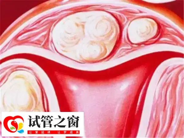 子宫内膜薄做试管婴儿能实现生育