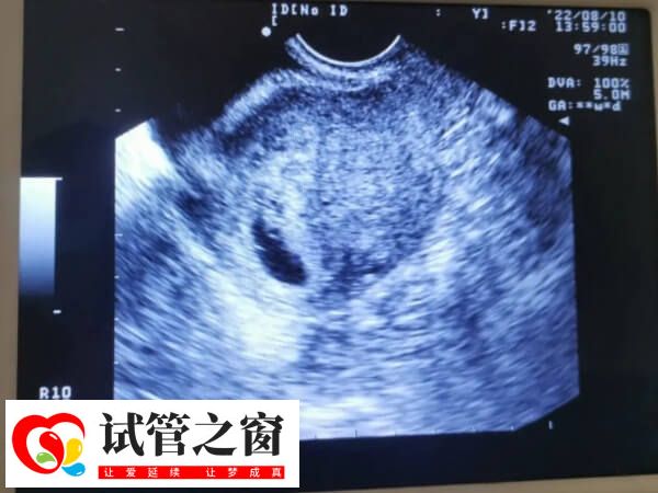 试管婴儿二超发现胎芽长度不足1.3cm是正常的吗?(图1) 试管二超胎芽长度是否正常要看患者情况