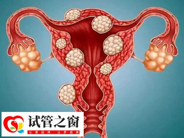 日喀则多发性子宫肌瘤做试管怀上双胞胎的成功率高吗?(图1) 子宫肌瘤过大需要手术切除