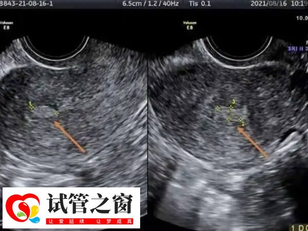 内膜回声不均匀怎么回事(图1) 内膜回声不均持续存在有疾病可能