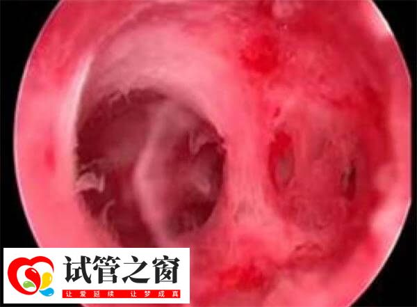 妊娠异常是宫腔粘连的常见症状之一