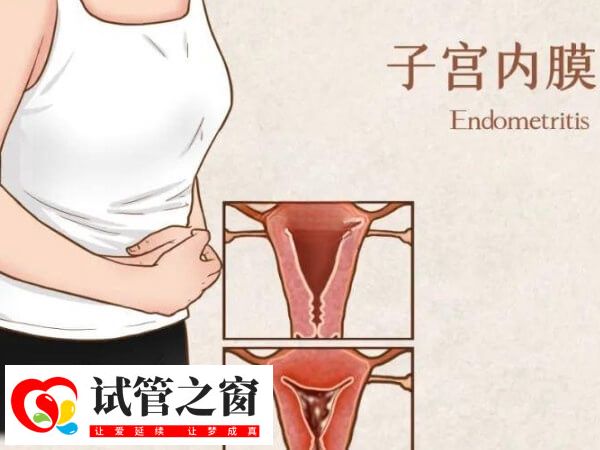 子宫内膜感染也会导致宫腔粘连